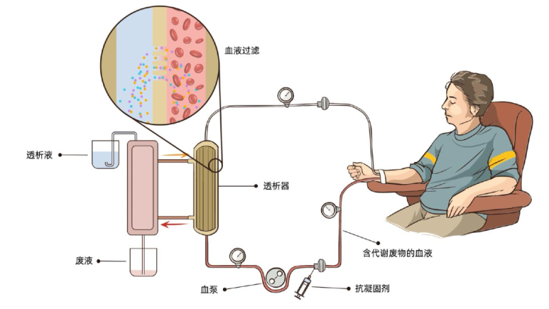 血液透析浓缩物同品种临床评价注册审查指导原则（征求意见稿）
