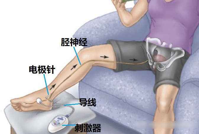 穿戴式经皮胫神经刺激器注册要点